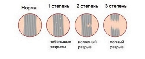Степени растяжения Степени растяжения