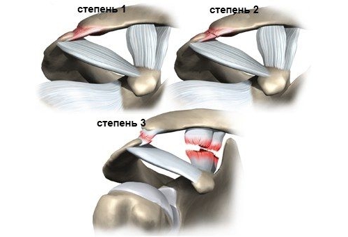 Степени разрыва акромиально-ключичного сочленения Степени разрыва акромиально-ключичного сочленения