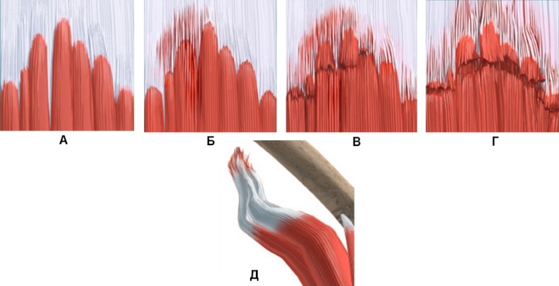 Степени разрыва мышц Степени разрыва мышц