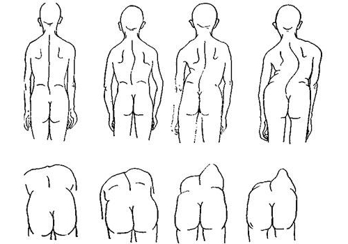 Степени рёберного горба Степени рёберного горба