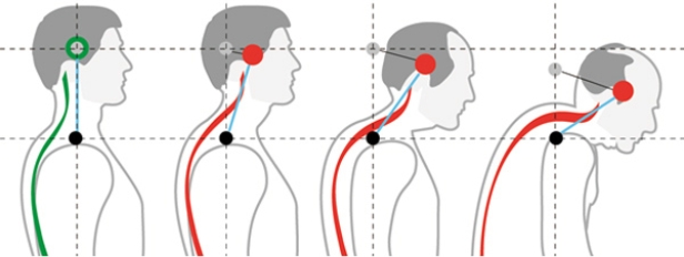Степени шейного лордоза Степени шейного лордоза