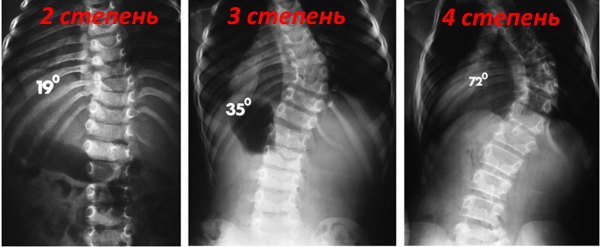 Степени сколиоза на рентген снимке Степени сколиоза на рентген снимке