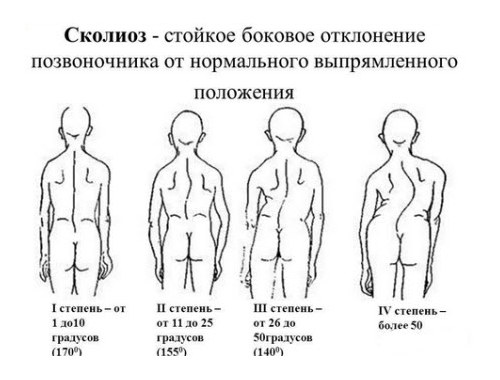Степени искривления при сколиозе Степени искривления при сколиозе