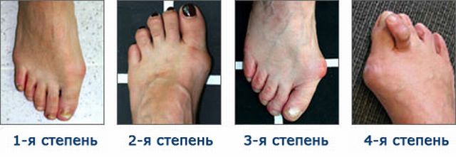 Степени вальгусной деформации большого пальца стопы Степени вальгусной деформации большого пальца стопы
