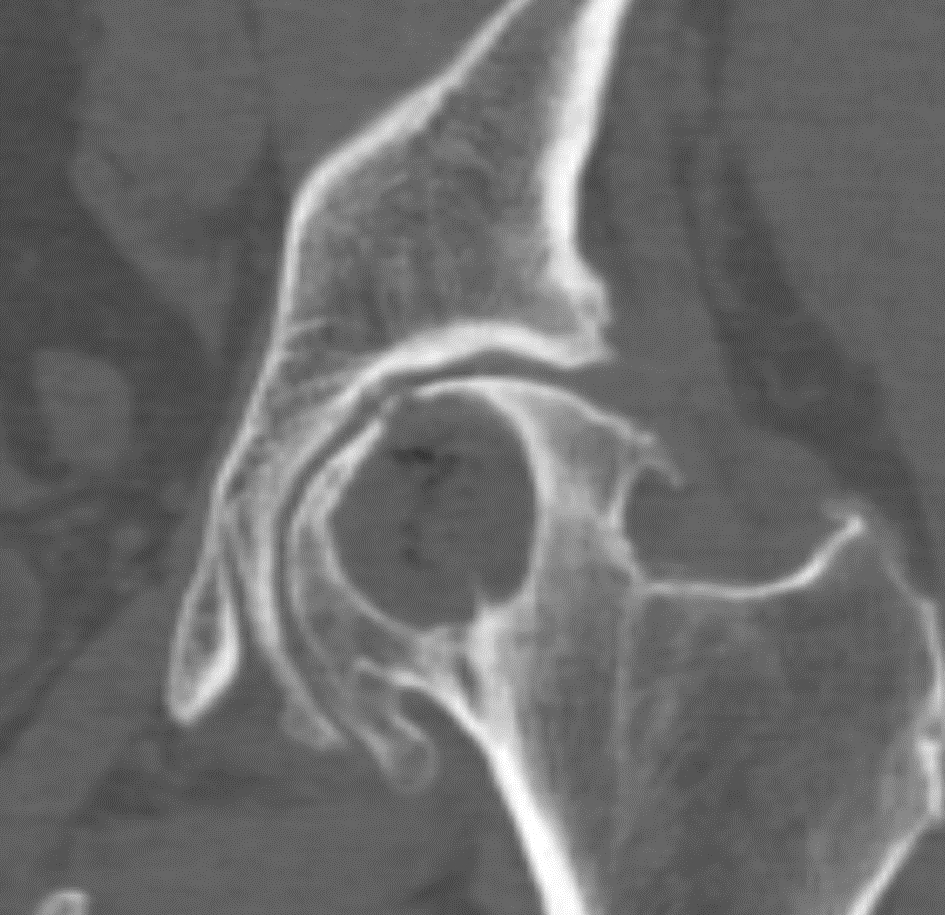 Субхондриальная киста на рентген снимке Субхондриальная киста на рентген снимке