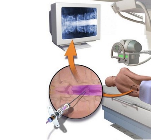 Суть миелографии Суть миелографии