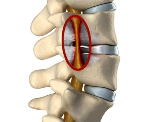 Сужение позвоночного канала Сужение позвоночного канала