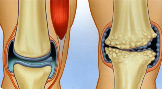 Сужение суставной щели Сужение суставной щели