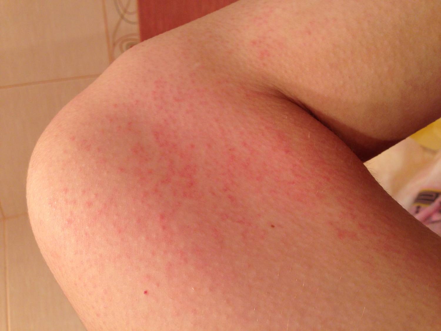 Сыпь на колене