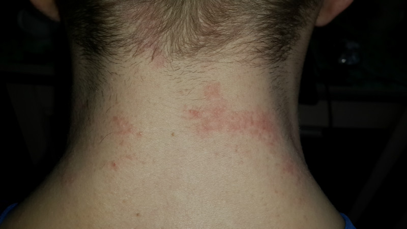 Сыпь на шее – противопоказание для компрессов с солью Сыпь на шее – противопоказание для компрессов с солью