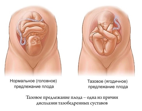 Неправильное предлежание плода Неправильное предлежание плода