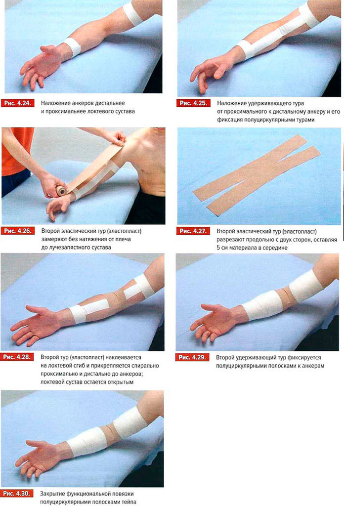 Пример тейпирования локтевого сустава Пример тейпирования локтевого сустава