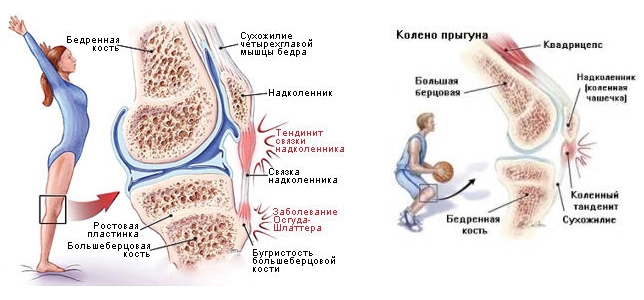 Тендинит из-за травмы колена Тендинит из-за травмы колена