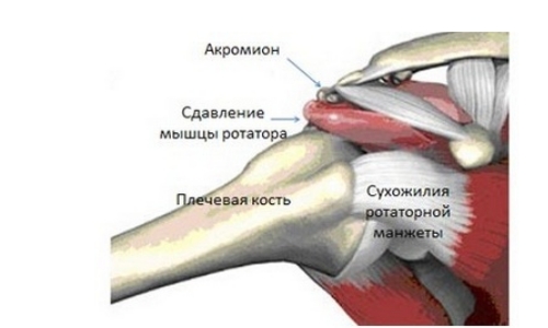 Тендинит ротаторной манжеты Тендинит ротаторной манжеты