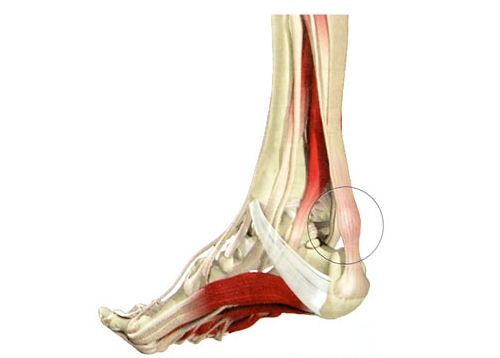 Тендиноз голеностопного сустава Тендиноз голеностопного сустава