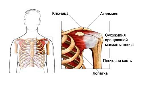 Тендиноз плечевого сустава Тендиноз плечевого сустава