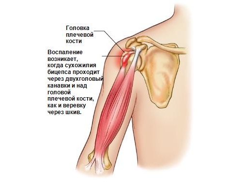 Теносиновит сухожилия длинной головки бицепса Теносиновит сухожилия длинной головки бицепса