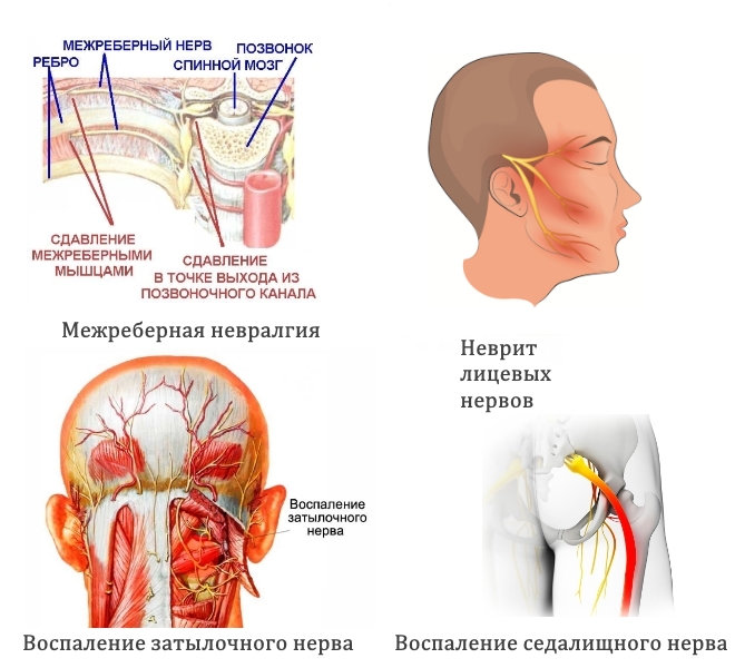 Частые зоны невралгии Частые зоны невралгии