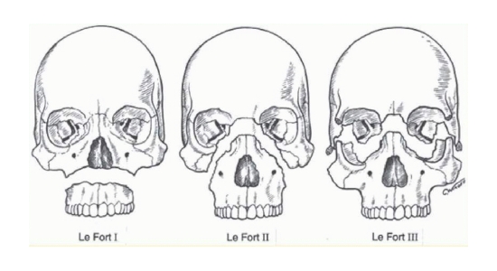 Типы переломов глазницы по Лефорту Типы переломов глазницы по Лефорту