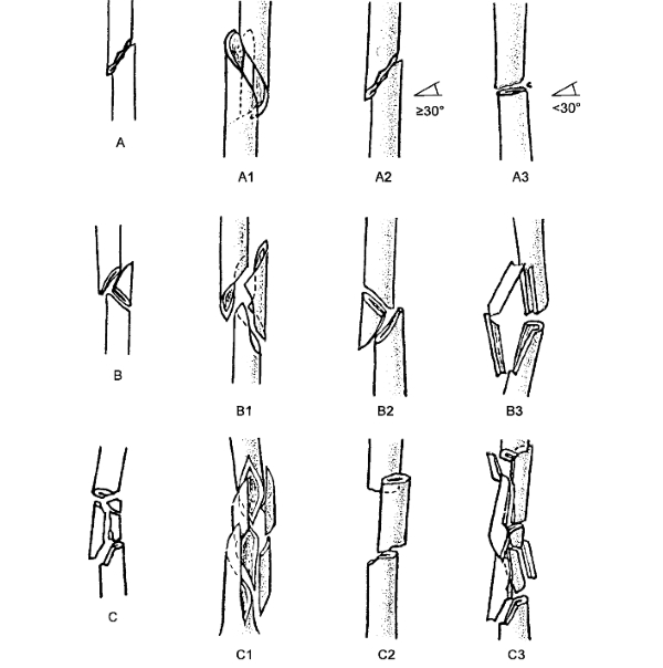 Типы переломов кости по направленности Типы переломов кости по направленности