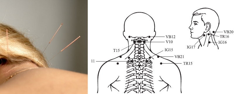 Точки акупунктуры при шейном остеохондрозе Точки акупунктуры при шейном остеохондрозе