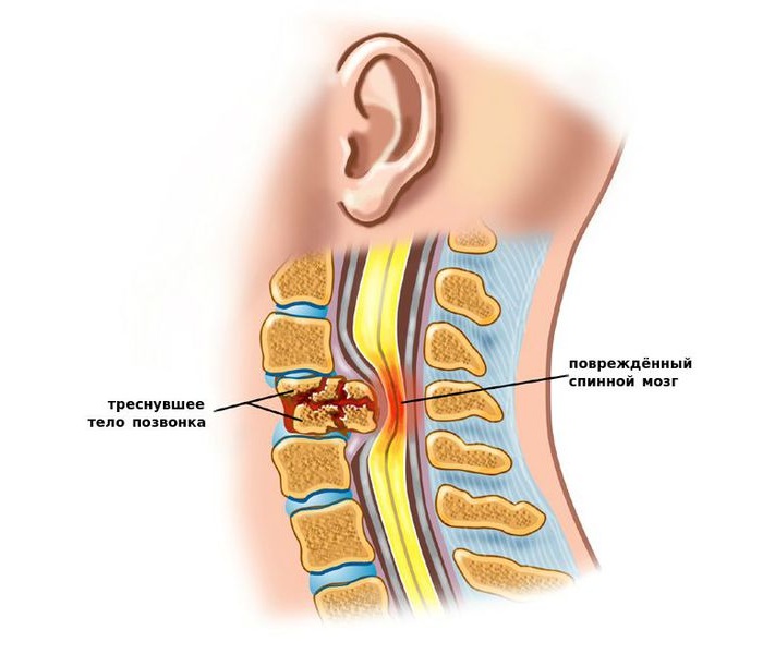 Травма позвонка шеи Травма позвонка шеи