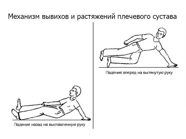 Травмирование плечевого сустава