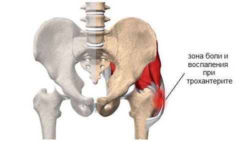 Зона боли при трохантерите Зона боли при трохантерите