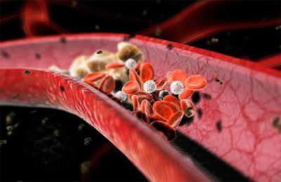 Тромб в сосудах Тромб в сосудах