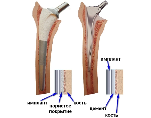 Цементный и бесцементный протез Цементный и бесцементный протез