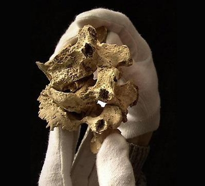 Туберкулез кости Туберкулез кости