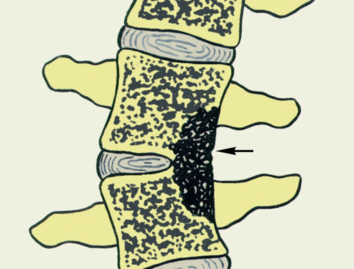 Инфекции в позвоночнике Инфекции в позвоночнике