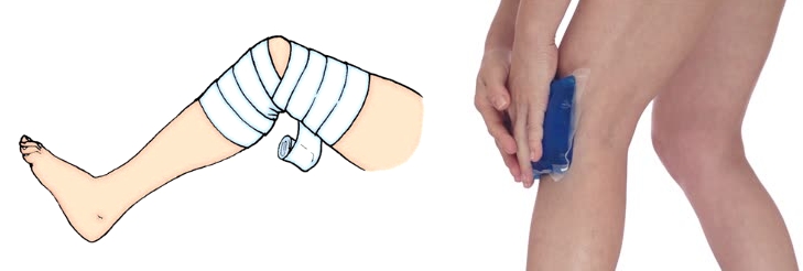 Тугая повязка и холодный компресс Тугая повязка и холодный компресс