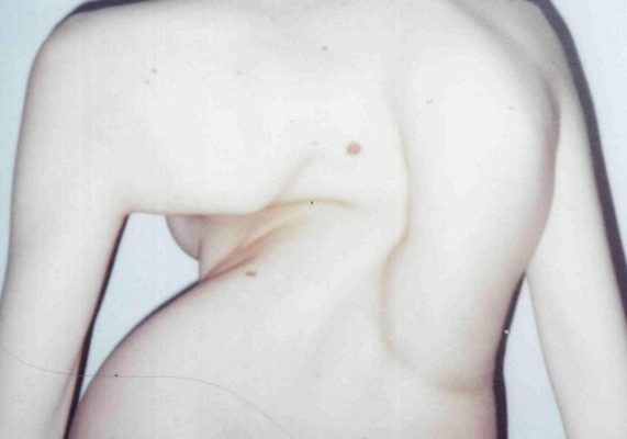 Тяжелый сколиоз Тяжелый сколиоз