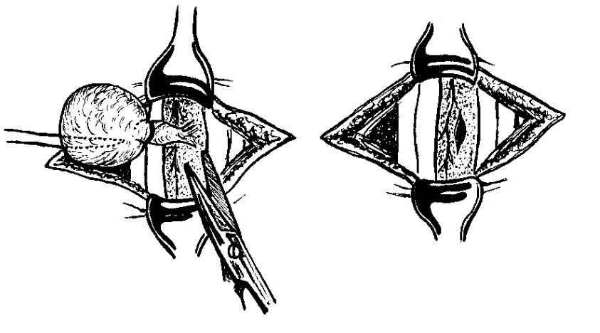Хирургическое удаление гигромы Хирургическое удаление гигромы