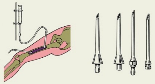 Удаление гноя при остеомиелите Удаление гноя при остеомиелите