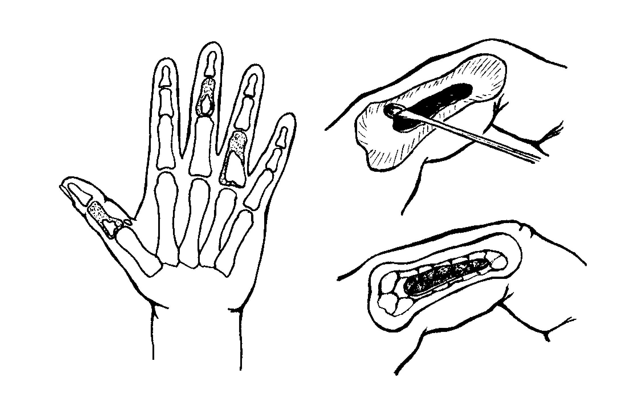 Удаление хондромы Удаление хондромы
