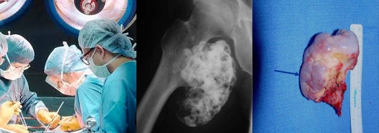 Хирургическое удаление остеохондромы Хирургическое удаление остеохондромы