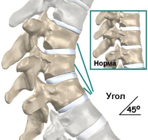Углообразный кифоз Углообразный кифоз