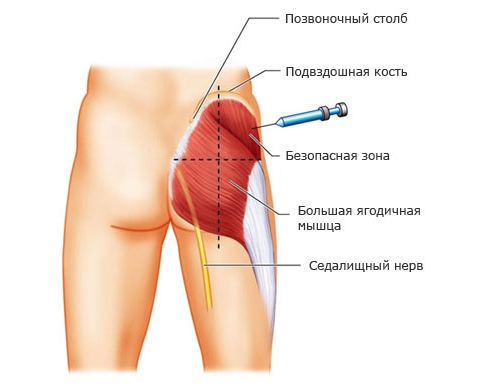 Внутримышечный укол Внутримышечный укол
