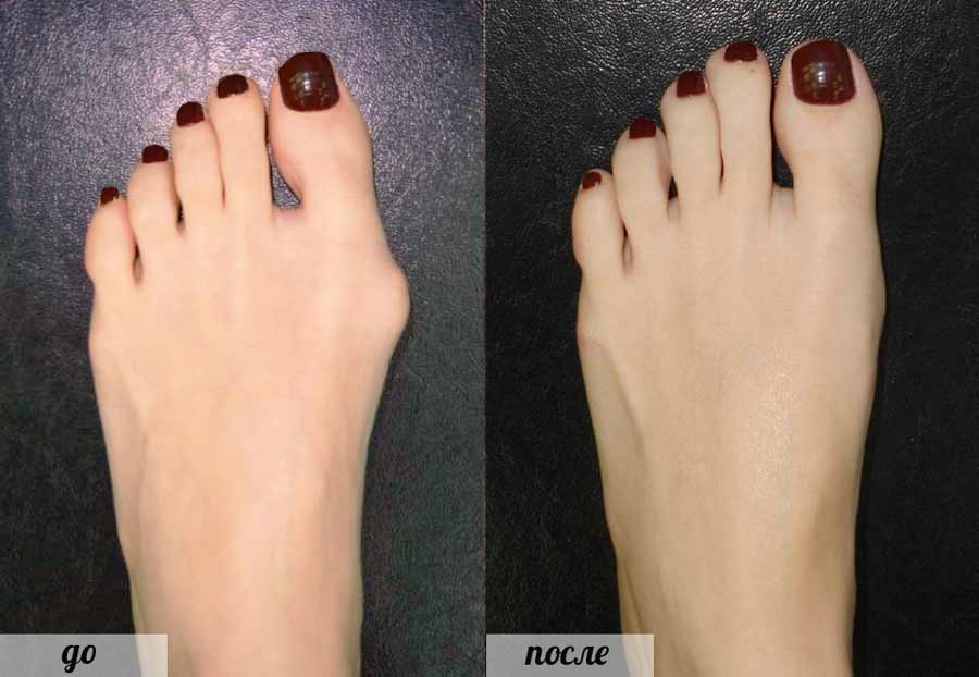 Уменьшение косточки на ноге Уменьшение косточки на ноге