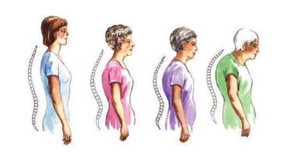 Уменьшение роста при остеопорозе Уменьшение роста при остеопорозе