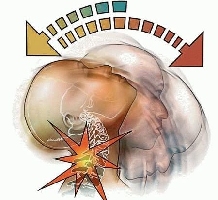 Ушиб шейных позвонков