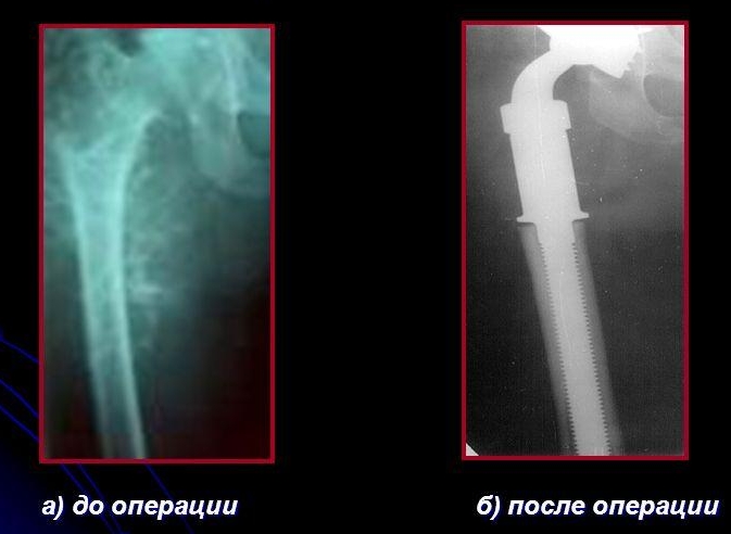 Установка эндопротезов в зоне удаления обширной хондросаркомы Установка эндопротезов в зоне удаления обширной хондросаркомы