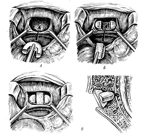 Установка трансплантанта Установка трансплантанта