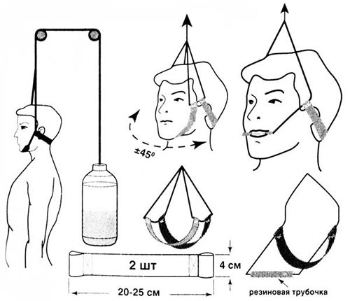 Вытяжение шейного отдела Вытяжение шейного отдела