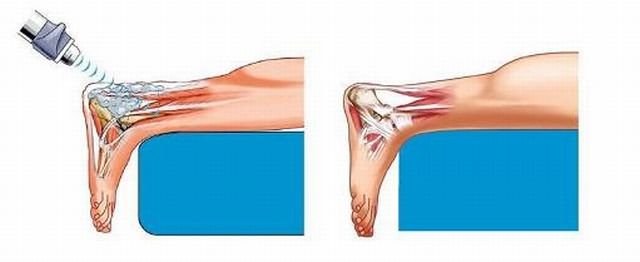 УВТ при энтезопатии УВТ при энтезопатии