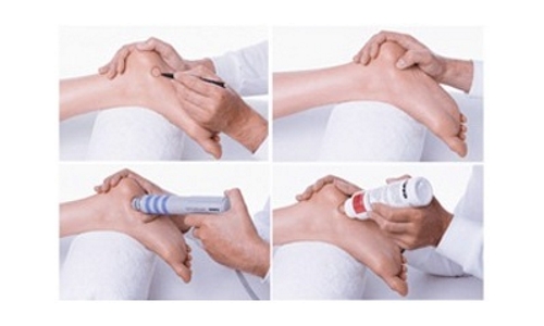 Этапы УВТ при пяточной шпоре Этапы УВТ при пяточной шпоре