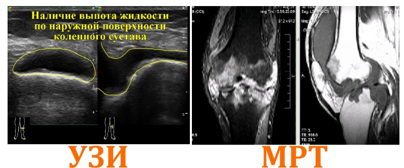 УЗИ и МРТ снимки колена УЗИ и МРТ снимки колена