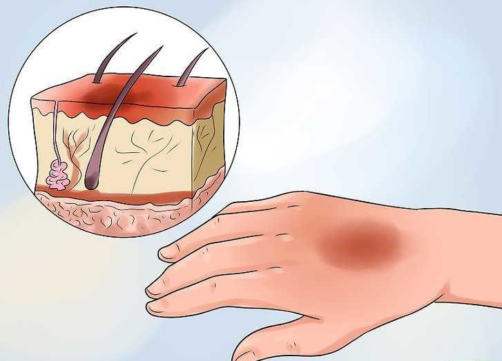 ожог первой степени